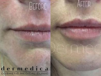 lip fillers in perth