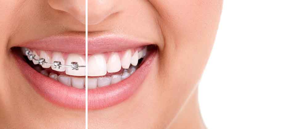 Veneers Cost in Houston: What You Need to Know