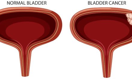 Gall Bladder Stone- Symptoms, Causes, and Treatment